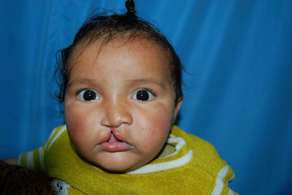 Anmolpreet as a baby before cleft surgery