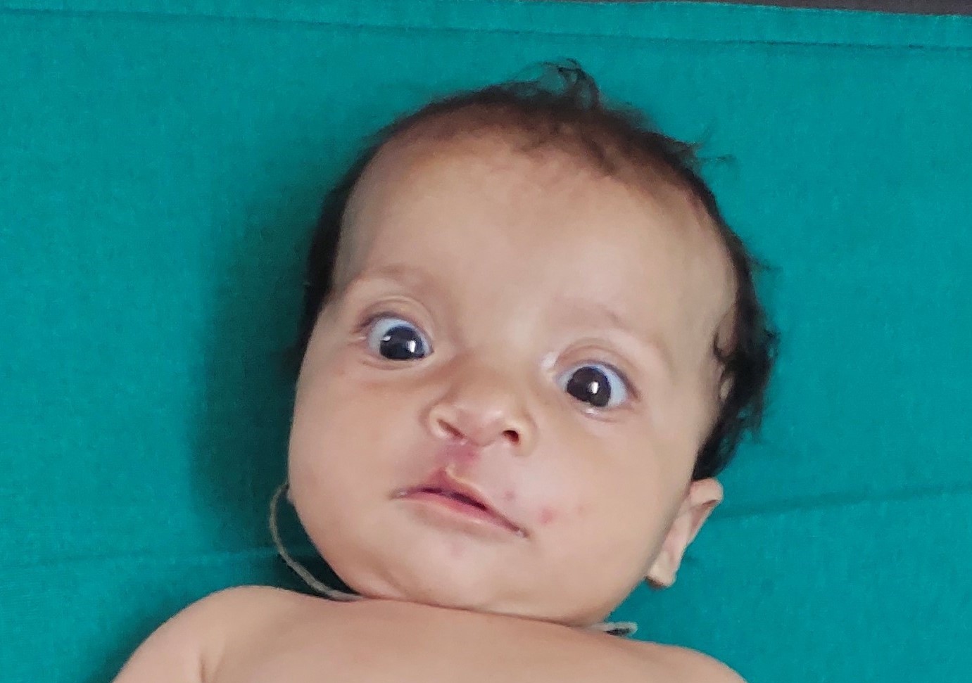 Sonali right after cleft surgery