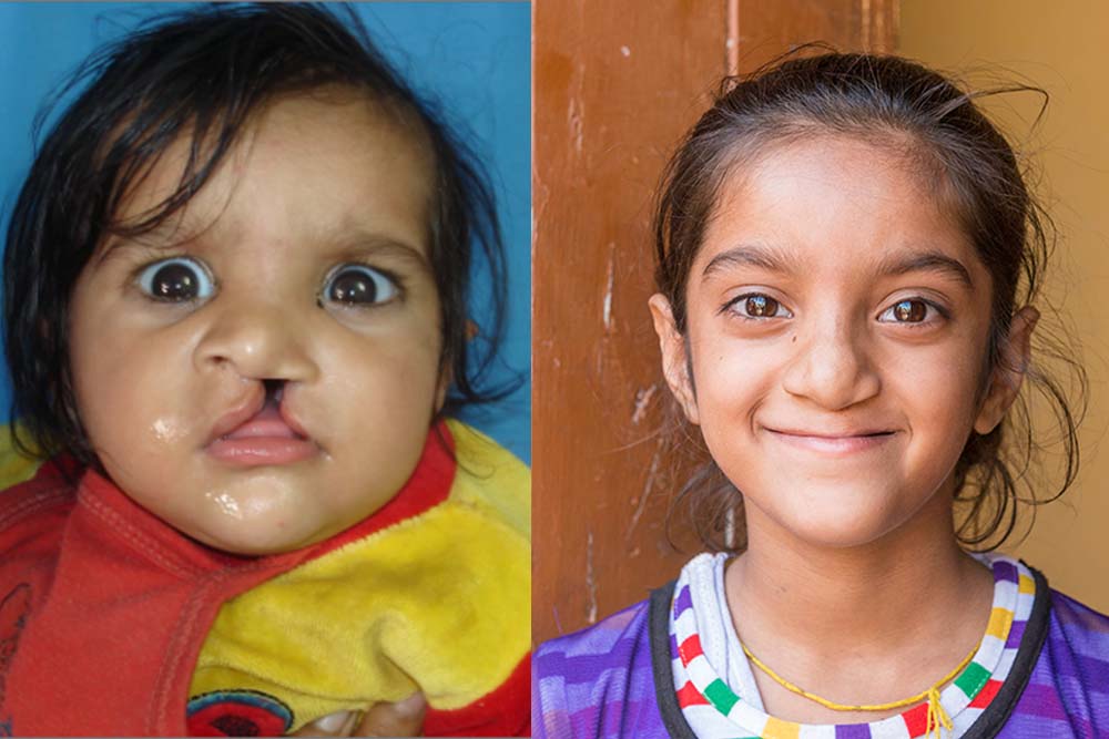 Anmol before and after cleft surgery