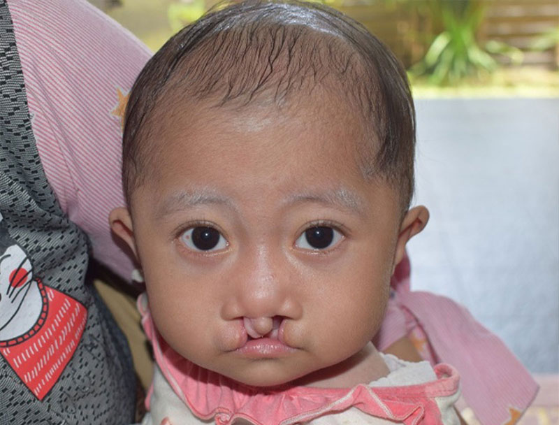 Smile Train patient Adiba before cleft surgery