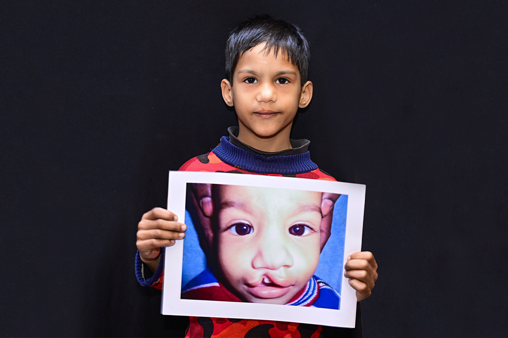 Hussain holding a picture of himself from before his cleft surgery