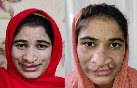 Bilques before and after cleft surgery