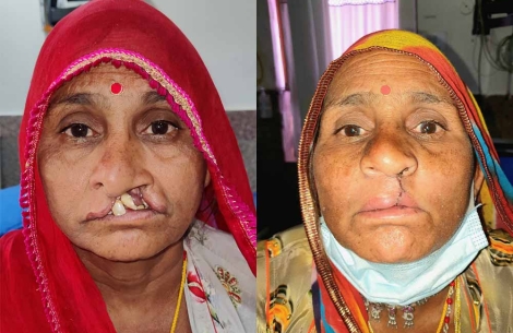 Dhapu Devi before and after cleft surgery