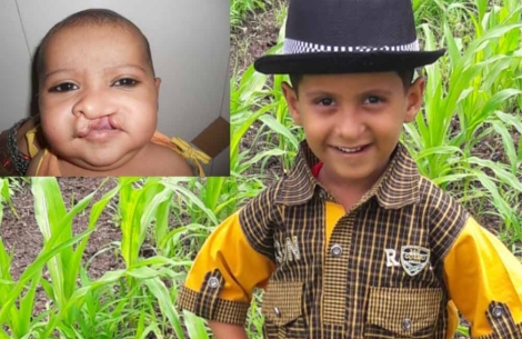 Nujen Khan before and after cleft surgery