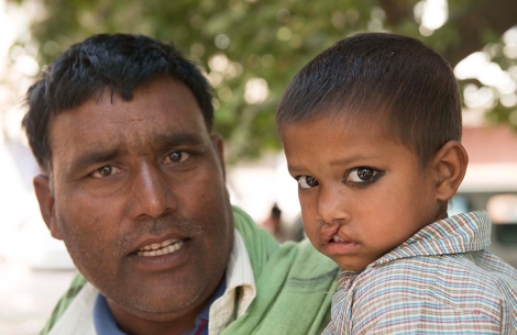 child with cleft with his father