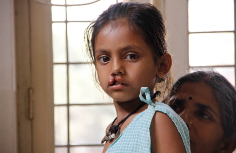 Girl with cleft lip