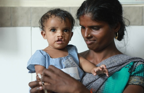 child with bilateral cleft lip