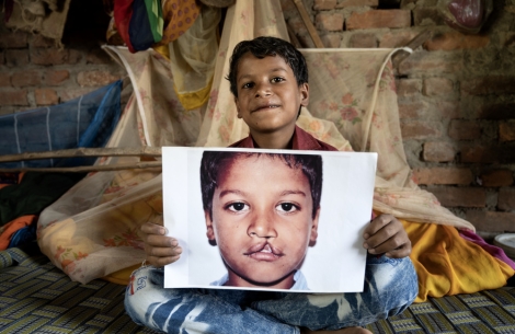 Shubham smiling and holding a photo of himself before cleft surgery