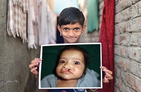 Yashoda smiling and holding a picture of herself before cleft surgery
