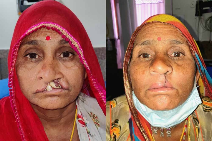 Dhapu Devi before and after cleft surgery