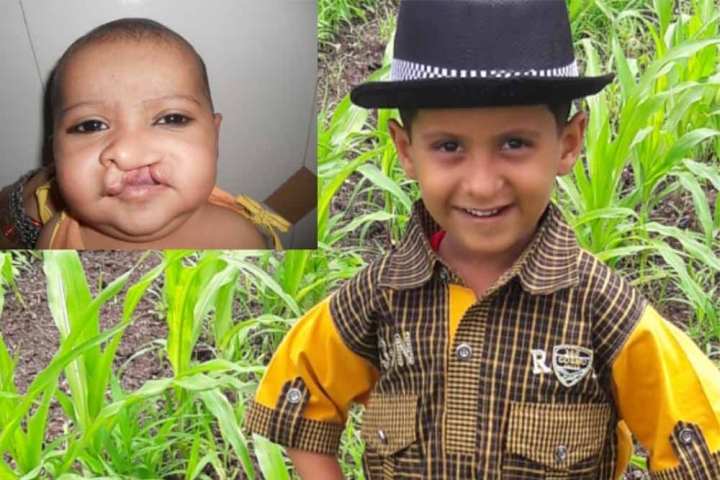 Nujen Khan before and after cleft surgery