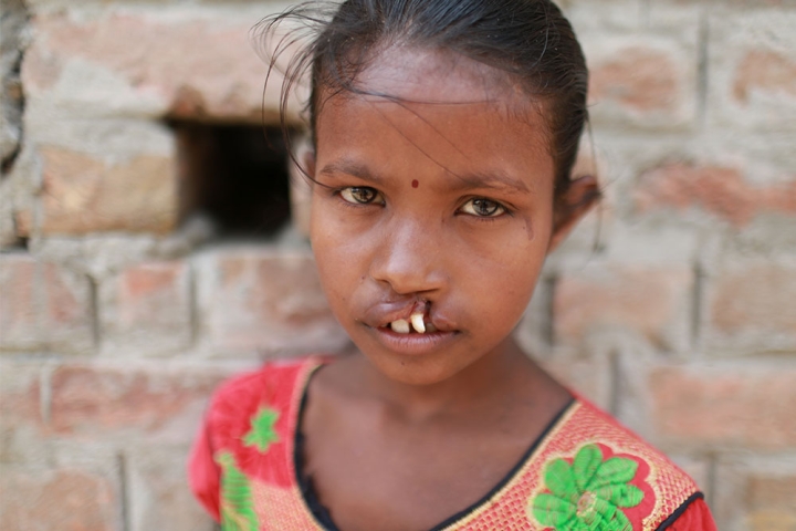 Girl with untreated cleft lip