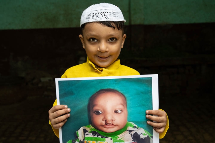 Boy hold image of himself before cleft lip surgery