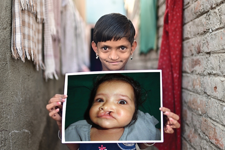 Yashoda smiling and holding a picture of herself before cleft surgery