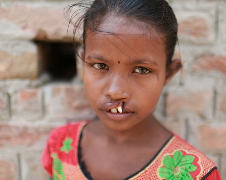Girl with untreated cleft lip
