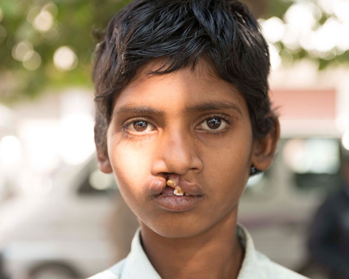 Boy with cleft lip from India