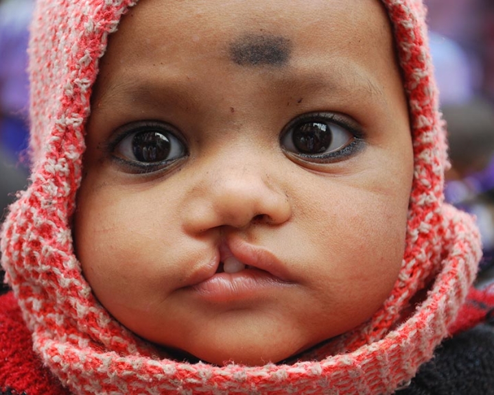 child from india with cleft lip