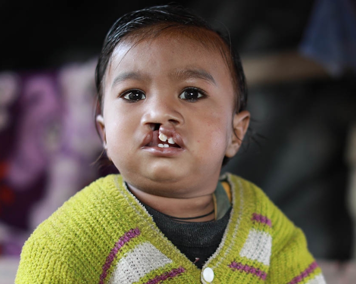baby looks at camera with untreated cleft lip
