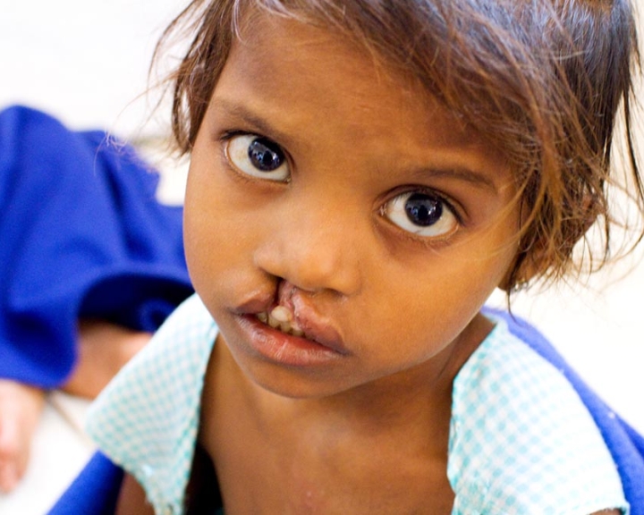girl with cleft