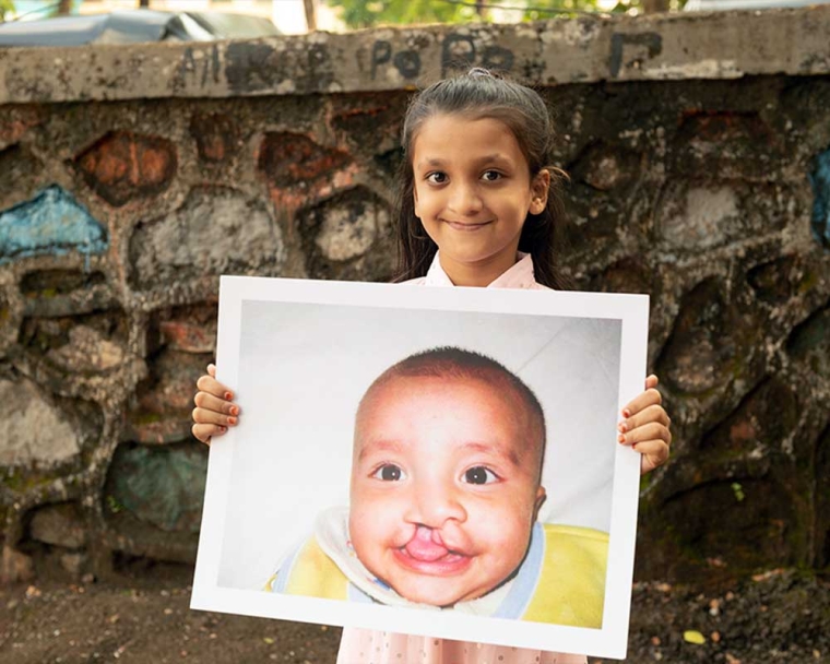 Humera smiling and holding a picture of herself before cleft surgery