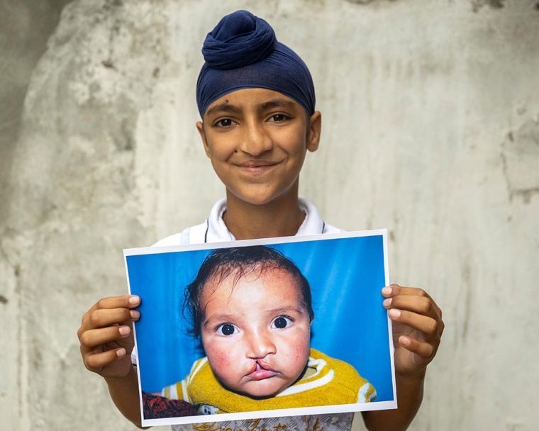 man holds up image of himself before cleft lip surgery