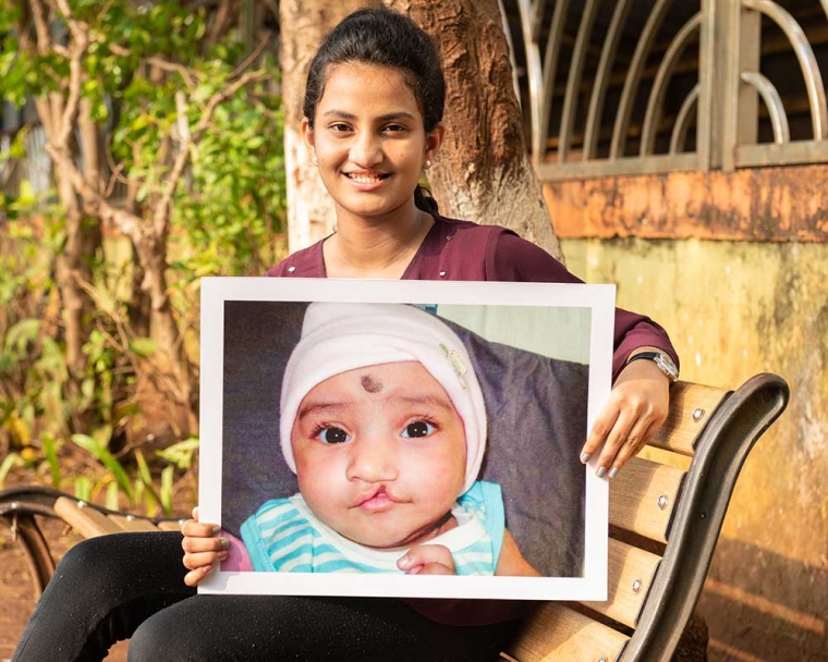 girl holds up image of herself before cleft lip surgery