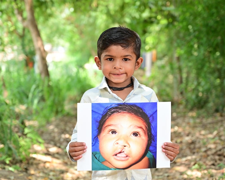 Jairaj smiling and holding a photo of himself before cleft surgery
